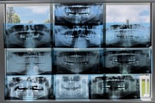 10 Dental Panoramic Full Mouth X-Rays Lot Vintage Teeth Cavities Tooth Jaw Films picture